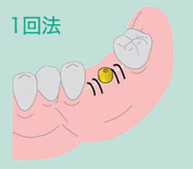 1回法