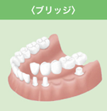 ブリッジ